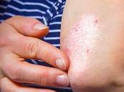 ¿Por psoriasis aumenta riesgo diabetes?