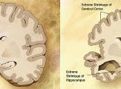 misteriosa enfermedad cerebral infantil África muestra sorprendente similitud Alzheimer (investigación)