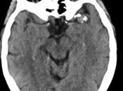 Caso clínico aneurisma arteria cerebral media segmento