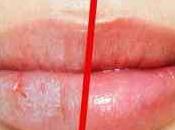 Labios agrietados