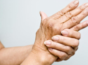 Artricenter: ¿Cómo saber sufrimos artritis reumatoide?