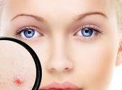¿Qué tratamiento idóneo para eliminar cicatrices acné?