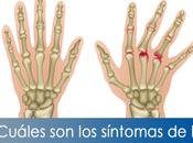 Artricenter: ¿Cuáles síntomas artritis reumatoide?