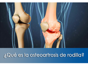 Artricenter: ¿Qué osteoartrosis rodilla?