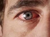 Cómo aliviar ojos rojos forma natural