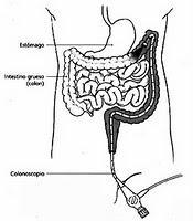 colonoscopia
