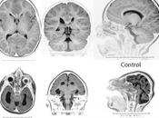 Fallos desarrollo cerebro ¿quién responsable?