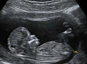 #Ciencia: #bebé nace “embarazada” hermano gemelo #Medicina #Salud #Barranquilla #Colombia