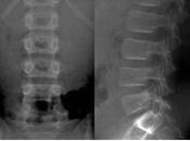 identificamos esta radiografía? fractura espondilolistesis Luxación compresión Imagen:
