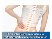 Artricenter: Cómo produce artrosis vertebral “espondiloartrosis”