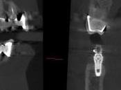técnica regeneración ósea guiada revoluciona colocación implantes dentales cuando falta hueso según