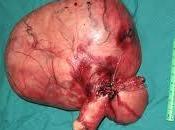 Trataminto Quirurgico Miomas Uterinos