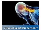 Artricenter: ¿Qué artrosis cervical?