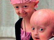 progeria alzheimer……