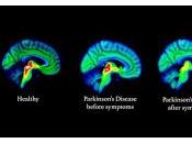 Descubren Primeros Signos Parkinson Cerebro