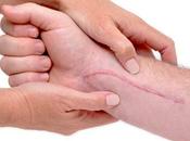 Tejido cicatricial: causas, prevención tratamiento