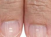 Manchas uñas
