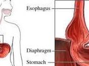 Consejos para hernia hiato