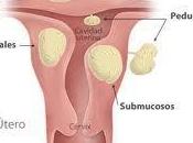 causas mioma uterino