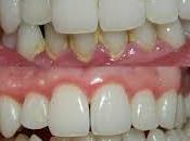 sangran encías? Alerta: GINGIVITIS
