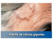 Artricenter: Arteritis células gigantes