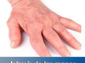 Artricenter: Artrosis manos
