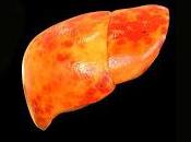 Prueban nuevo fármaco para Tratar Hígado Graso Alcohólico