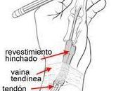 ¿Sufres tendinitis?