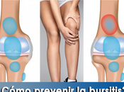 Artricenter: ¿Cómo prevenir bursitis?