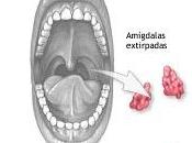 faltaba: amigdalectomía incrementa riesgo infarto cardíaco