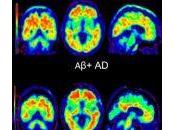 Asociaciones actividad física β-amiloide cognición longitudinal neurodegeneración adultos mayores clínicamente normales.