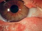 ¿Has sufrido alguna blefaritis?