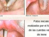 Cura cuerdas vocales inflamadas canto