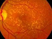 Descubren Causa Degeneración Macular relacionada Edad