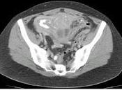 Abscesos Pelvicos Origen Colonico