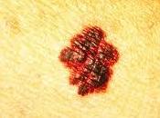 Presentada Barcelona técnica invasiva para tumores cutaneos