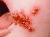 impétigo: infección contagiosa piel
