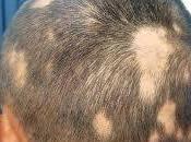Cómo tratar alopecia areata Solución tratamiento