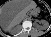 Bilioma