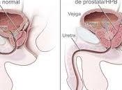 Diagnosticados 18.000 cánceres próstata España