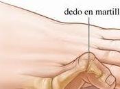 dedos martillo