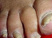 Onicomicosis: enfermedad uñas