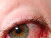 Uveítis: inflamación desconocida