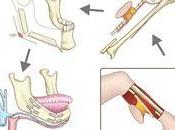 manises reconstruye mandíbula paciente implante peroné