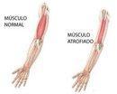 Distrofia muscular fisioterapia terve