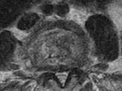 Discitis Resonancia Magnetica