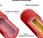 ¿Qué arteriosclerosis?