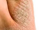 Cómo tratar psoriasis?