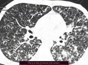 Hallazgos compatibles tuberculosis pulmonar miliar.