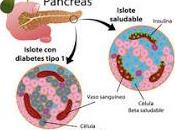 tratamiento experimental puede revertir diabetes tipo